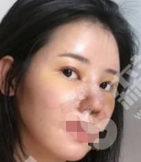 南京柏盛医疗美容医院隆鼻技术怎么样？附案例分享