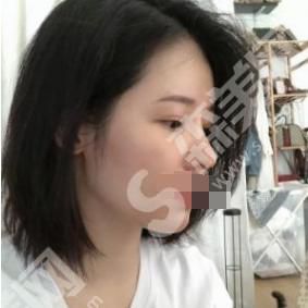南京柏盛医疗美容医院隆鼻技术怎么样？附案例分享