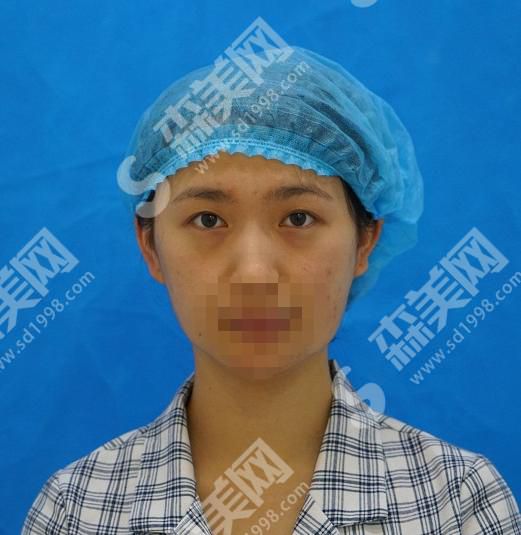 天津哪个公立医院有医美？内含医院介绍及双眼皮案例分享