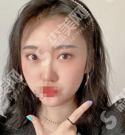 信阳中心医院整形科做的双眼皮果怎么样？附真人果分享