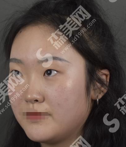 信阳中心医院整形科做的双眼皮果怎么样？附真人果分享