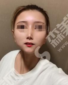 西京医院做的激光祛斑怎么样?附医师介绍及案例分享