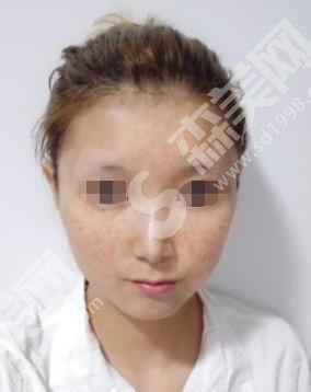 西京医院做的激光祛斑怎么样?附医师介绍及案例分享