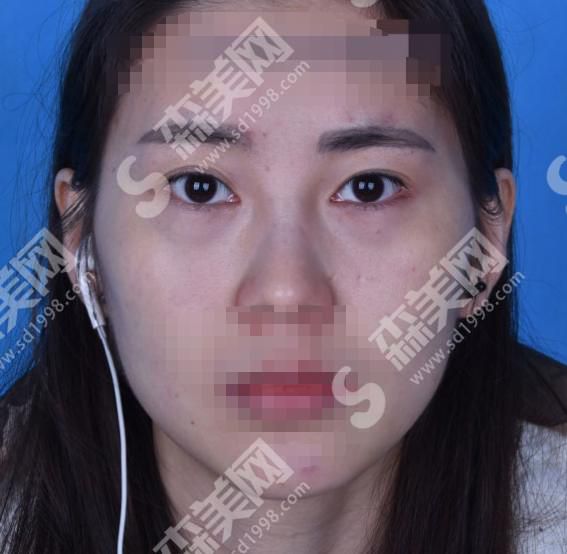 成都恩喜整形美容医院正规吗？双眼皮案例分享来袭~