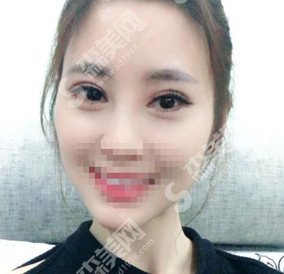 成都恩喜整形美容医院正规吗？双眼皮案例分享来袭~