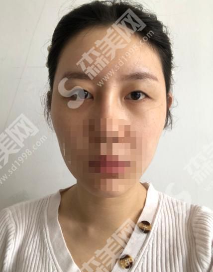 米兰柏羽整形医院怎么样?内含医师介绍及双眼皮案例分享