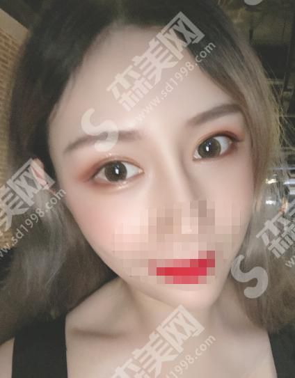 米兰柏羽整形医院怎么样?内含医师介绍及双眼皮案例分享