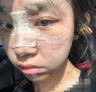 上海伊莱美整形美容医院自体肋软骨隆鼻果怎么样？在分享整形价格标准＋案例前后对比图