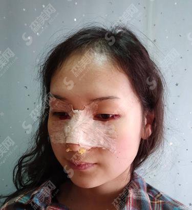 医大一院整形外科隆鼻价格参考！含隆鼻案例果对比照