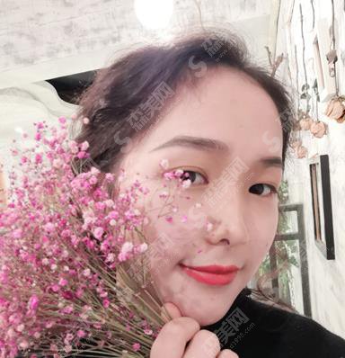 医大一院整形外科隆鼻价格参考！含隆鼻案例果对比照