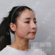 修复改脸型医院哪家好？上海时光下颌角整形案例分享＋图片欣赏