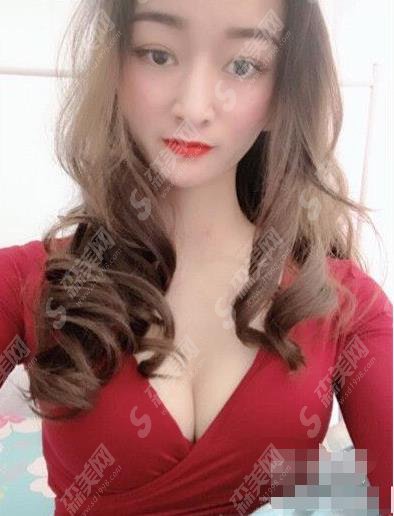 贵港人民医院整形美容中心脂肪隆胸果分享，价格表出炉啦！