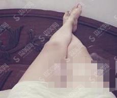 营口协和整形美容医院脱毛案例果,价格查询及图片欣赏