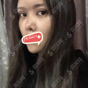 太原时光整形医院是正规医院吗?膨体隆鼻手术安排以后瞬间变成气质美女