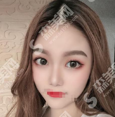 洛阳协和整形医院双眼皮果怎么样？附医生介绍及案例分享