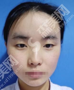 广州曙光和华美哪家技术好？曙光整形医院双眼皮案例分享