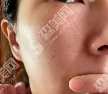 广州中山大学附属第三医院做激光美肤怎么样?激光美肤案例对比图