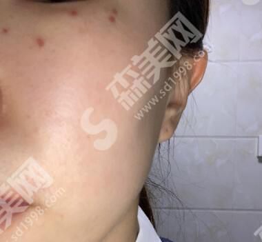 广州中山大学附属第三医院做激光美肤怎么样?激光美肤案例对比图