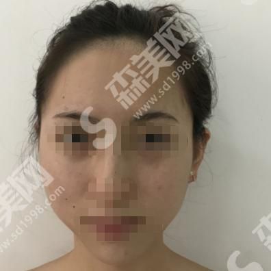 成都丝缘毛发医院怎么样？附植发果分享