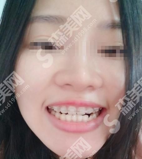 许昌口腔医院做的牙齿矫正果怎么样?附医院介绍及案例分享