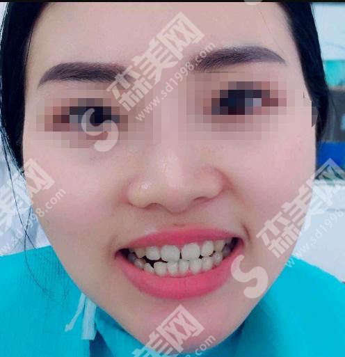 许昌口腔医院做的牙齿矫正果怎么样?附医院介绍及案例分享