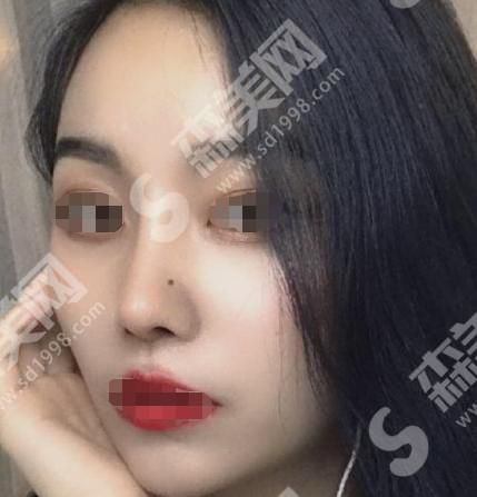 漯河缔美整形医院做的隆鼻果怎么样？附医师介绍及案例分享