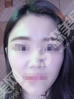 漯河缔美整形医院做的隆鼻果怎么样？附医师介绍及案例分享