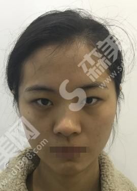 扬州苏北人民医院整形科做的双眼皮怎么样？真人案例分享