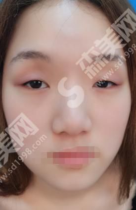 厦门美莱和华美哪个医院更好？附厦门美莱双眼皮案例分享