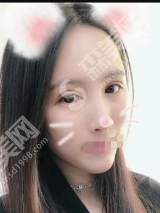 山东省立医院做的光子嫩肤怎么样?果超好~