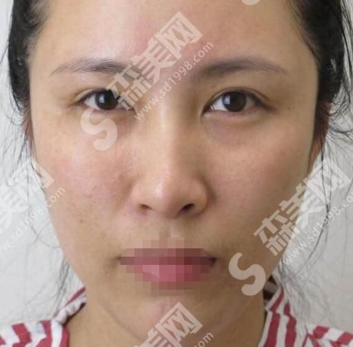 山东省立医院做的光子嫩肤怎么样?果超好~