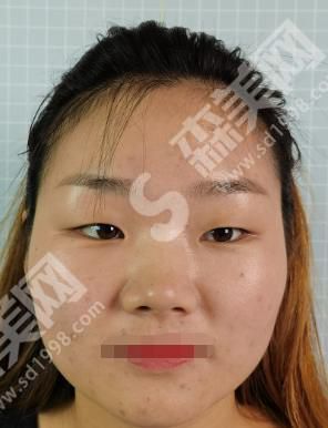 成都西区医院邓东伟医生的技术怎么样?真人整形案例分享来袭~