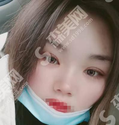 成都西区医院邓东伟医生的技术怎么样?真人整形案例分享来袭~