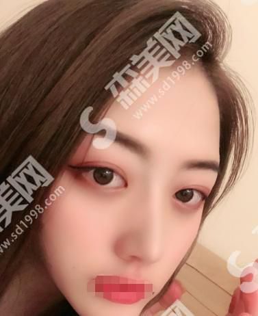 大理韩美医疗美容医院做的隆鼻果怎么样？附医师介绍