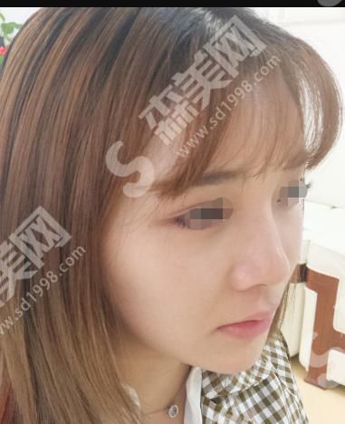 圣嘉荣整形医院是三甲医院吗?真人隆鼻案例分享