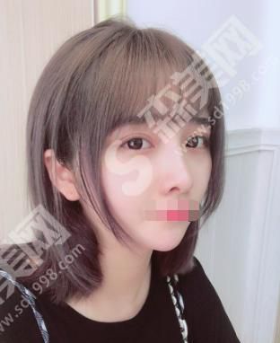 圣嘉荣整形医院是三甲医院吗?真人隆鼻案例分享