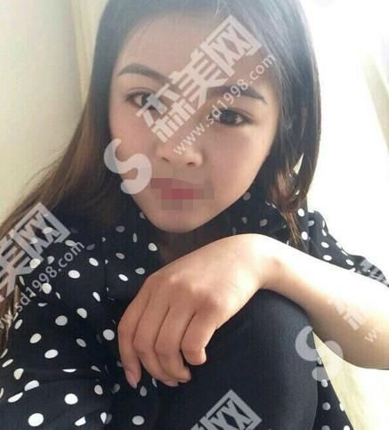 太原华美整形美容医院隆鼻果好不好?附医生介绍及案例分享