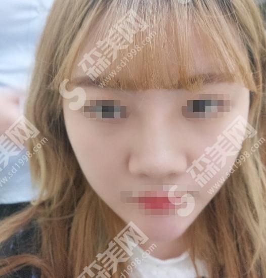中南大学湘雅三医院怎么样？真人隆鼻案例分享~