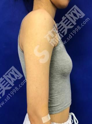 成都友谊医院是公立还是私立?附隆胸安利分享