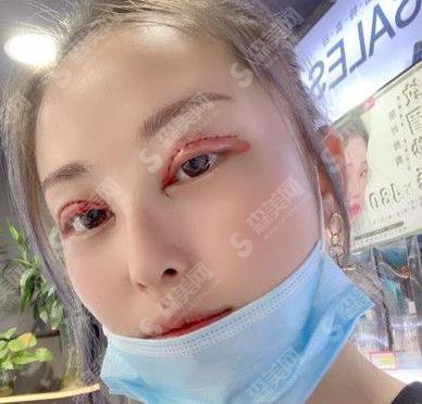 临沂卫康整形美容医院眼部手术术后果图一览,2021眼部整形价格