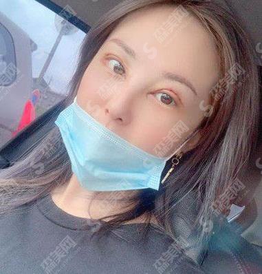 临沂卫康整形美容医院眼部手术术后果图一览,2021眼部整形价格