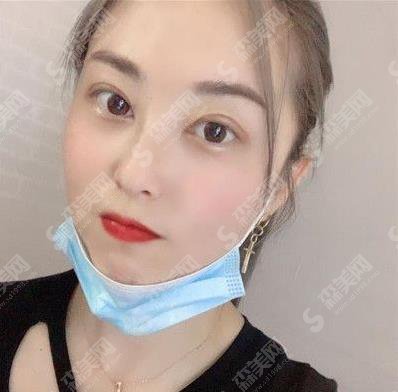 临沂卫康整形美容医院眼部手术术后果图一览,2021眼部整形价格