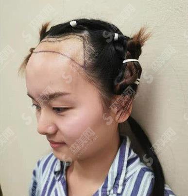 长沙美莱整形美容医院发际线种植案例分享及价格表不要错过!
