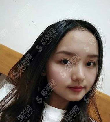 长沙美莱整形美容医院发际线种植案例分享及价格表不要错过!
