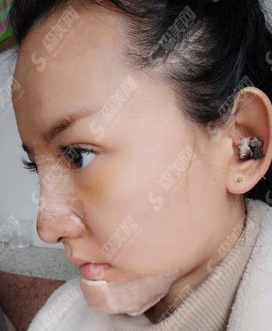 田永成整形美容医院自体耳软骨隆鼻价格,在分享隆鼻案例果图欣赏