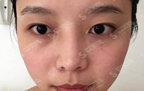 上海第九人民医院整形外科专家哪个较好?李青峰眼部整形案例分享