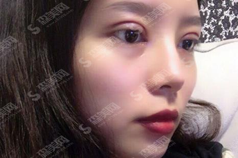 上海第九人民医院整形外科专家哪个较好?李青峰眼部整形案例分享