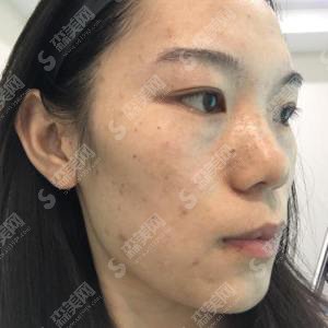 潍坊博雅整形医院像素激光祛斑的果对比图大分享,含较新的整形价目表