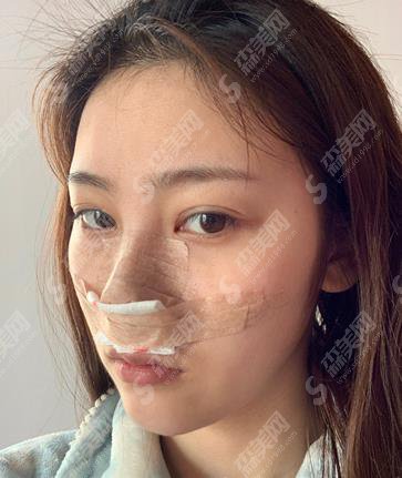 深圳薇姿医疗假体隆鼻怎么样?隆鼻案例揭晓及隆鼻价格查询