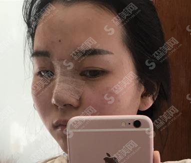 塘沽隆鼻开展的顺利吗?价格参考出炉及案例展示